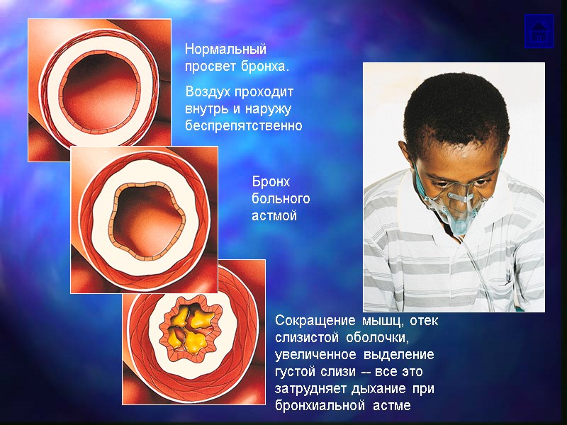 Нормальный просвет бронха. Воздух проходит внутрь и наружу беспрепятственно Бронх больного астмой Сокращение мышц,